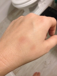 GROSS WARNING: Fun fact, when I throw up, I headbutt my hand, resulting in this lovely bruise